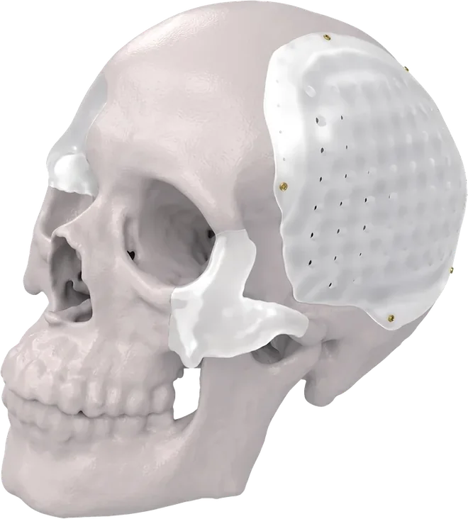 Patient-specific cranial implant fitted to a skull model, covering a parietal defect