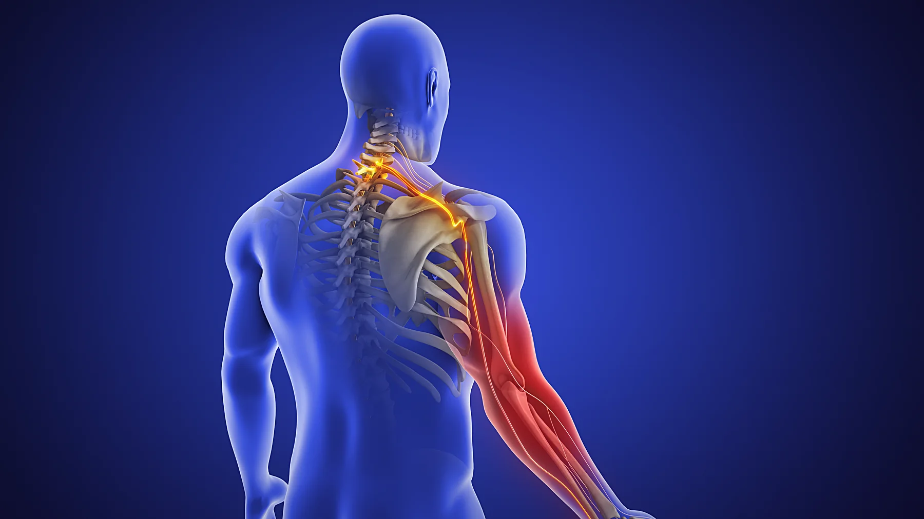 Illustration of a cervical nerve root compressed at the neck, with symptoms radiating into the arm