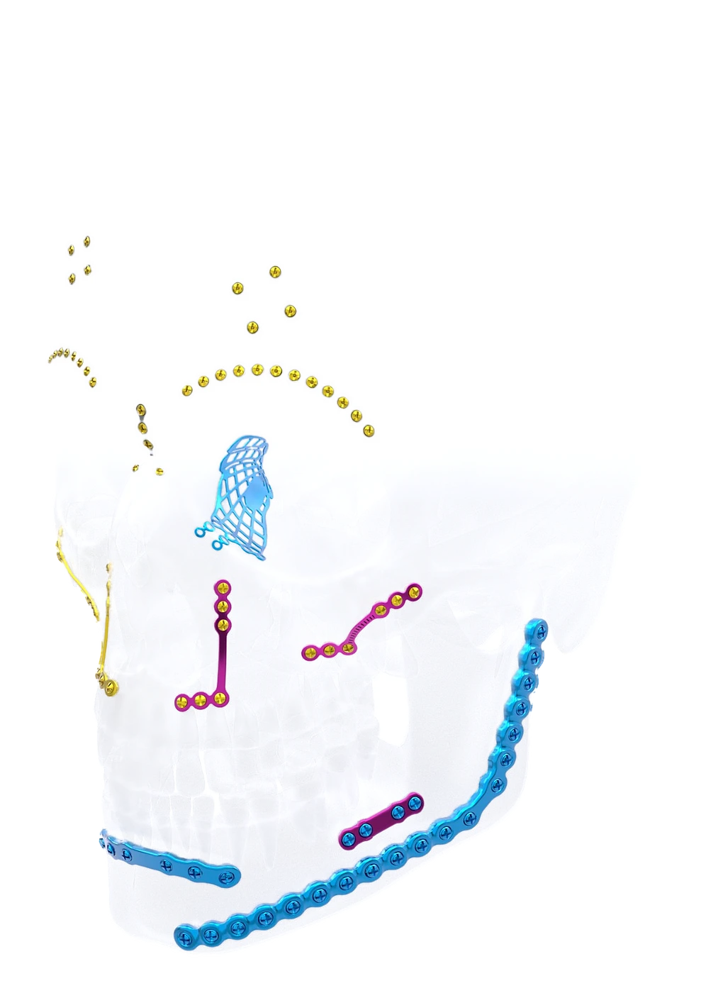Titanium cranio-maxillofacial plates, mesh and screws on a translucent skull model