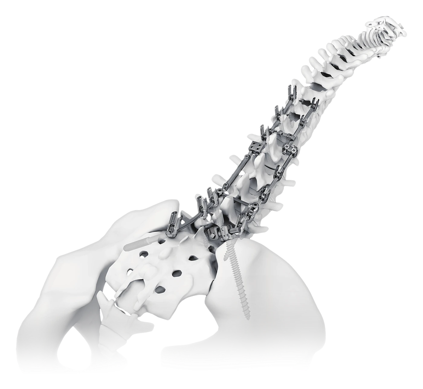 HOBBIT posterior fixation construct on a spine and pelvis model