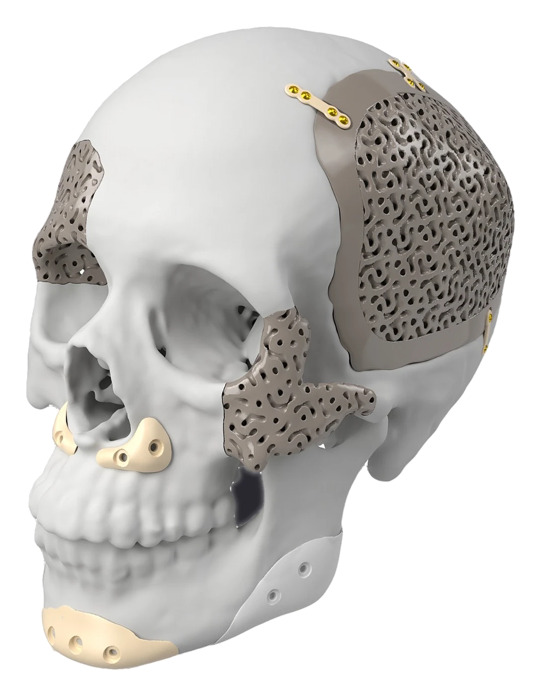 PEEK + BCP patient-specific cranial and facial implants on a skull model